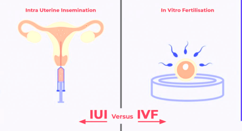 IVF or IUI Which One Is Better for You?